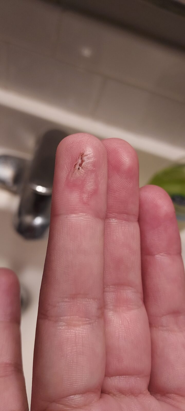 A healed scar on Lyn's fingertip — the cheerful aftermath of working on a car battery